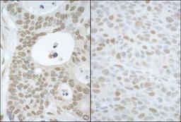 Immunohistochemistry-Paraffin: TIP120A Antibody [NBP1-49918] - Sample: FFPE section of human ovarian carcinoma (left) and mouse hybridoma tumor (right).  Antibody was used at a dilution of 1:5,000 (0.2 and 1:1,000 (1 Detection: DAB