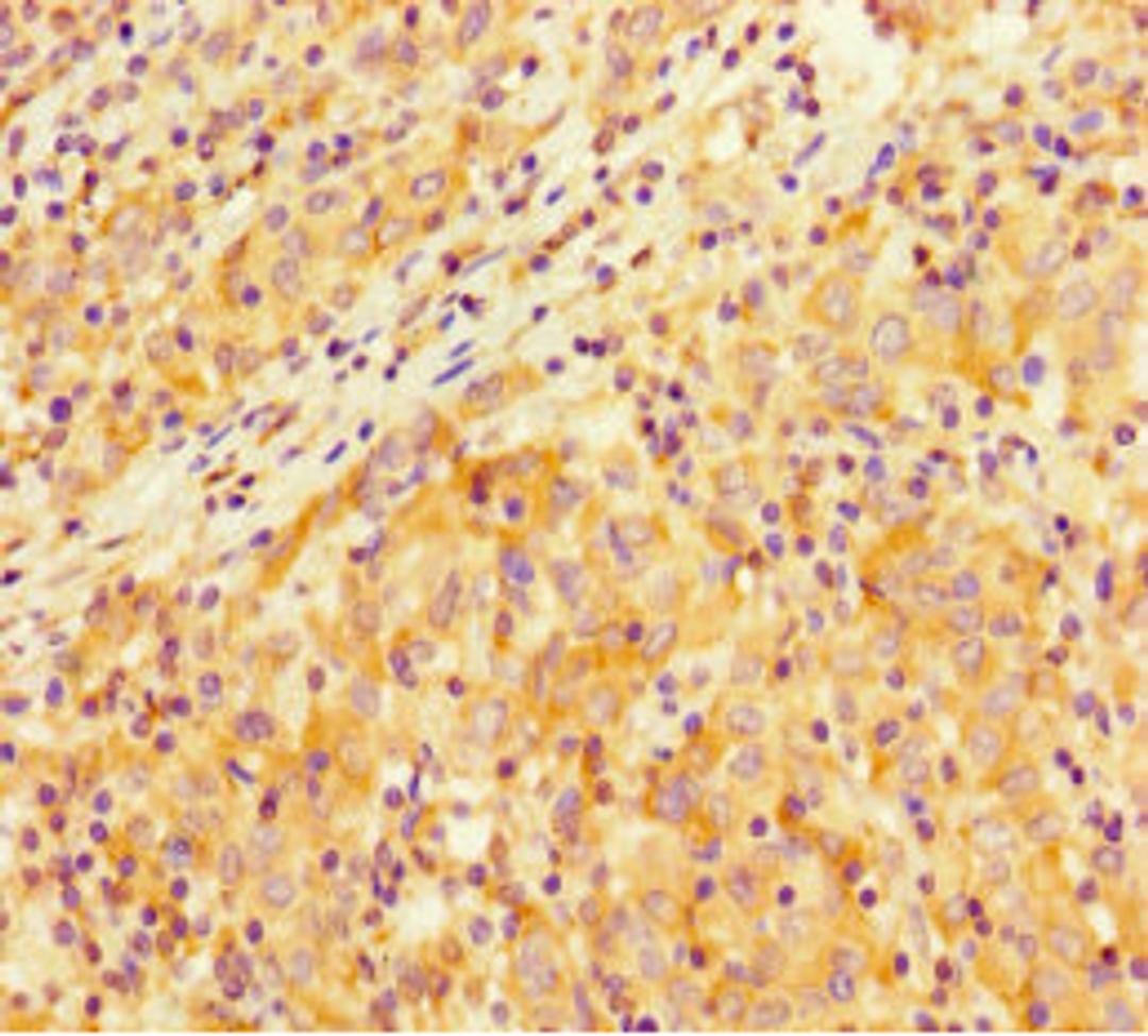 Immunohistochemistry of paraffin-embedded human lung cancer using CSB-PA021801LA01HU at dilution of 1:100