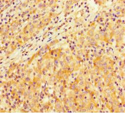 Immunohistochemistry of paraffin-embedded human lung cancer using CSB-PA021801LA01HU at dilution of 1:100