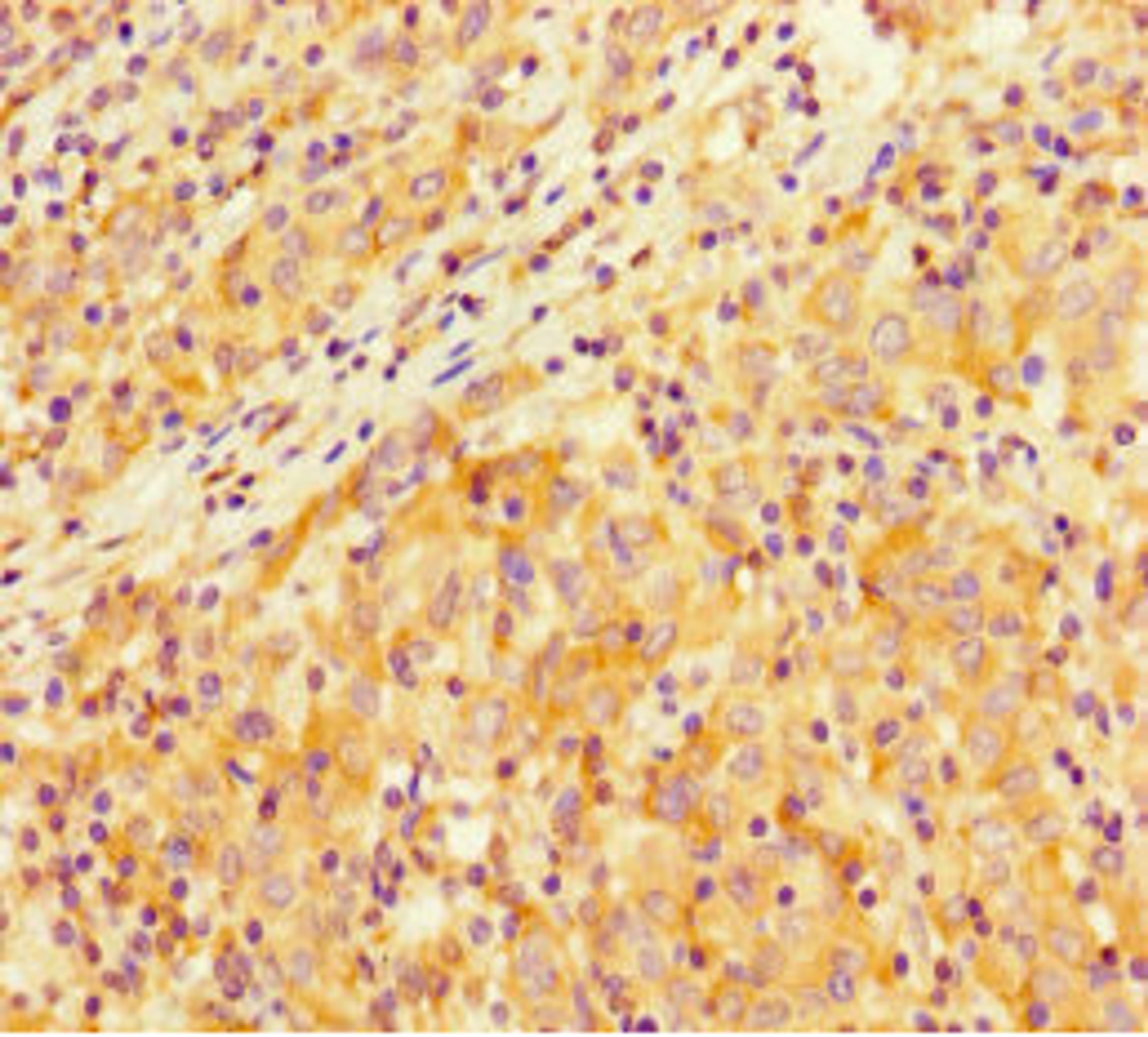 Immunohistochemistry of paraffin-embedded human lung cancer using CSB-PA021801LA01HU at dilution of 1:100