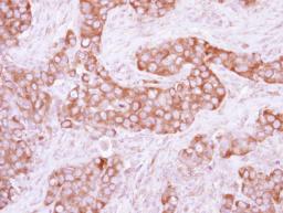 Immunohistochemistry-Paraffin: Pyruvate Kinase Antibody [NBP2-20027] - Immunohistochemical analysis of paraffin-embedded Breast ca, using antibody at 1:250 dilution.