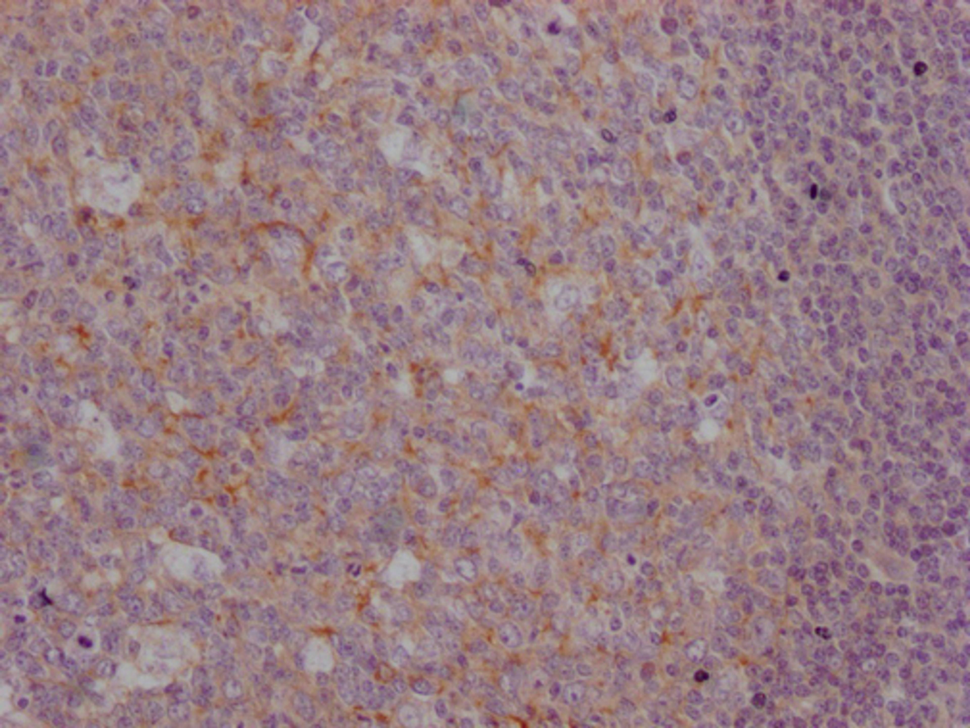 IHC image of CSB-MA916751 diluted at 1:100 and staining in paraffin-embedded human tonsil tissue performed on a Leica BondTM system. After dewaxing and hydration, antigen retrieval was mediated by high pressure in a citrate buffer (pH 6.0). Section was blocked with 10% normal goat serum 30min at RT. Then primary antibody (1% BSA) was incubated at 4°C overnight. The primary is detected by a Goat anti-mouse IgG polymer labeled by HRP and visualized using 0.05% DAB.