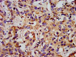 IHC image of CSB-PA009728LA01HU diluted at 1:300 and staining in paraffin-embedded human liver cancer performed on a Leica BondTM system. After dewaxing and hydration, antigen retrieval was mediated by high pressure in a citrate buffer (pH 6.0). Section was blocked with 10% normal goat serum 30min at RT. Then primary antibody (1% BSA) was incubated at 4&deg;C overnight. The primary is detected by a biotinylated secondary antibody and visualized using an HRP conjugated SP system.