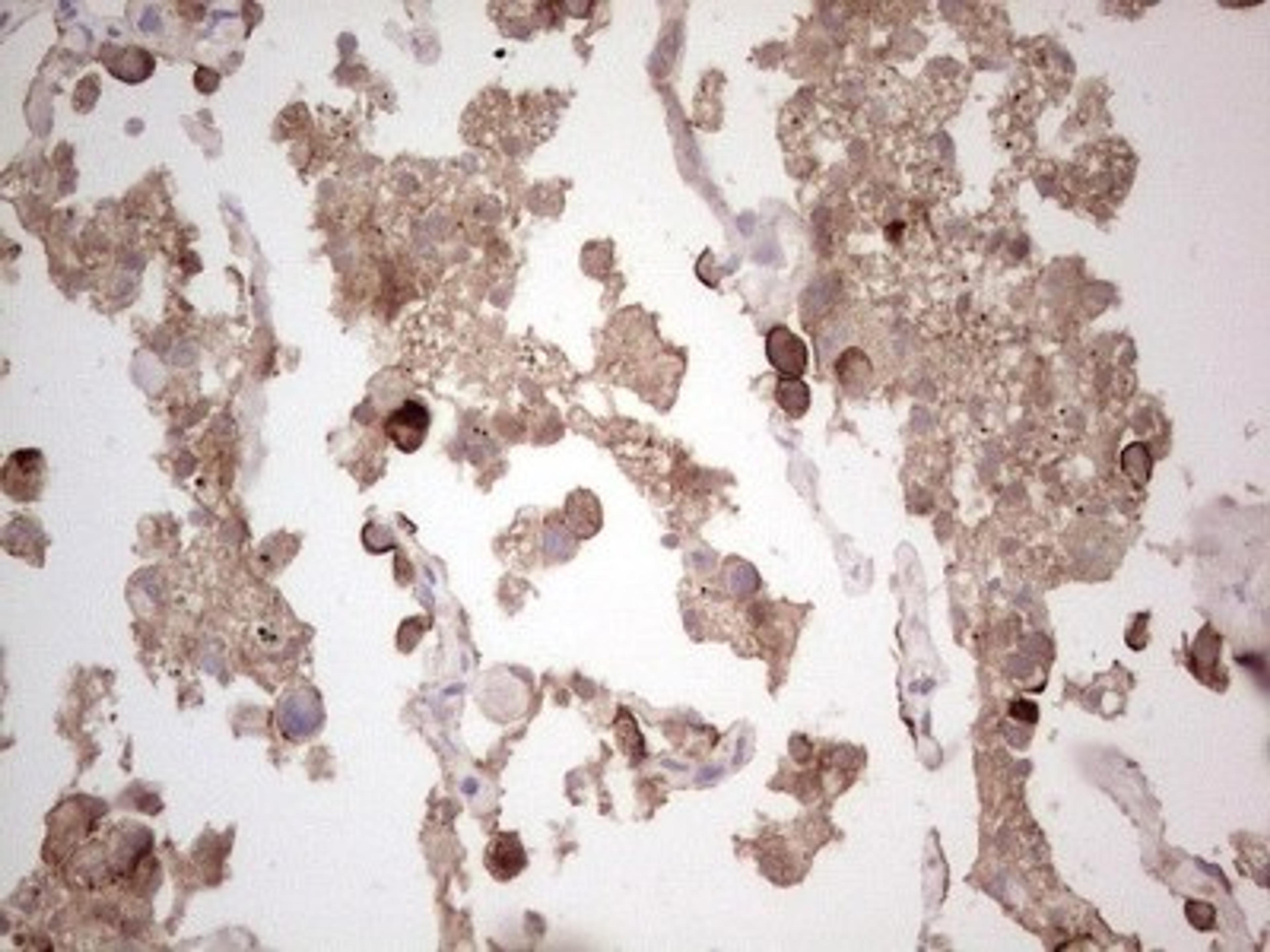 Immunohistochemistry: ROS Antibody (1F3) [NBP2-45626] - Analysis of Carcinoma Human lung tissue.