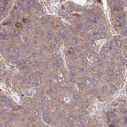 Immunohistochemistry: LCNL1 Antibody [NBP2-32521] - liver cancer