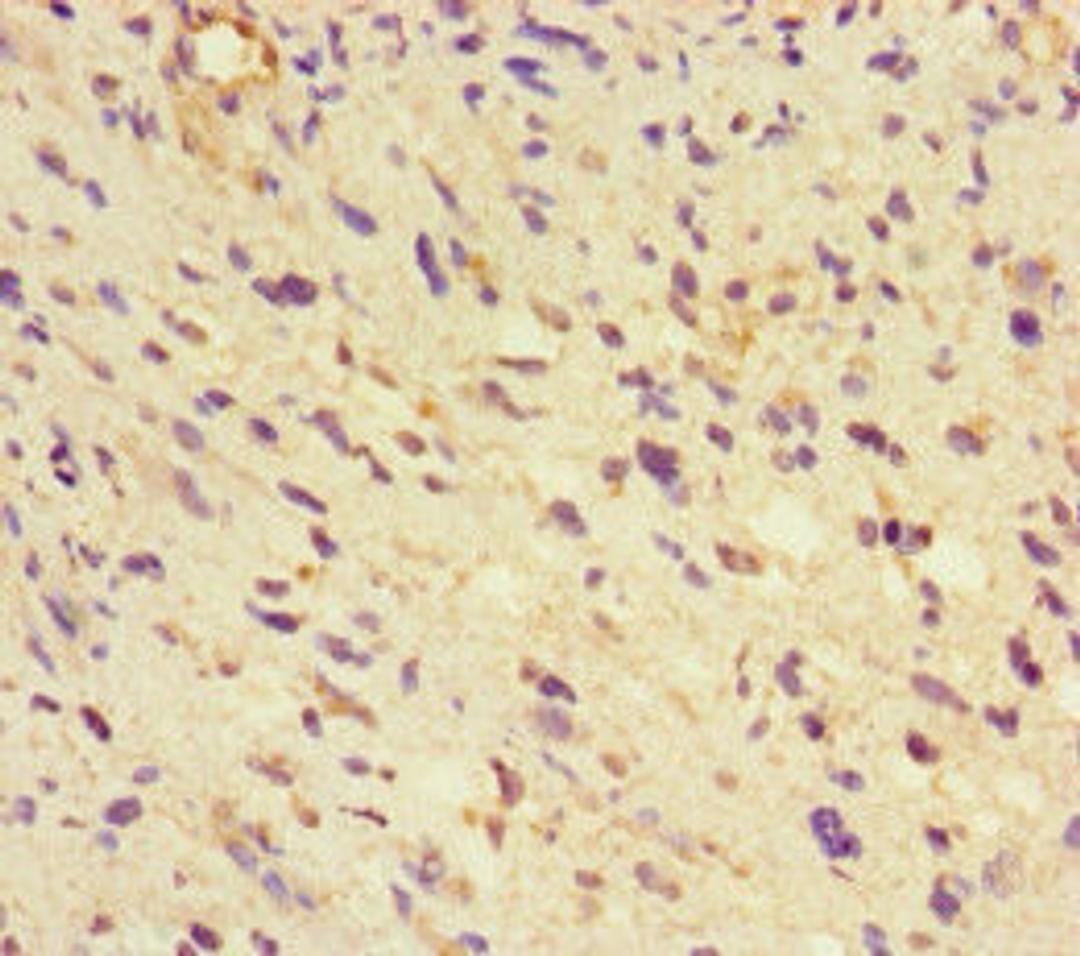 Immunohistochemistry of paraffin-embedded human glioma using CSB-PA009553LA01HU at dilution of 1:100