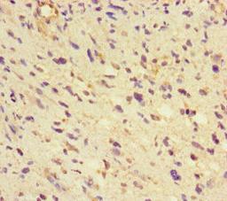 Immunohistochemistry of paraffin-embedded human glioma using CSB-PA009553LA01HU at dilution of 1:100