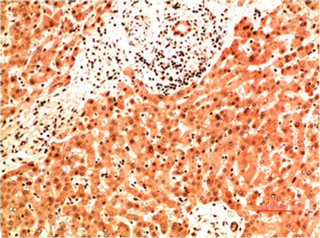 Immunohistochemical analysis of paraffin-embedded Human Liver Carcinoma Tissue using Collagen IV  Mouse mAb diluted at 1:200.