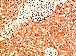 Immunohistochemical analysis of paraffin-embedded Human Liver Carcinoma Tissue using Collagen IV  Mouse mAb diluted at 1:200.