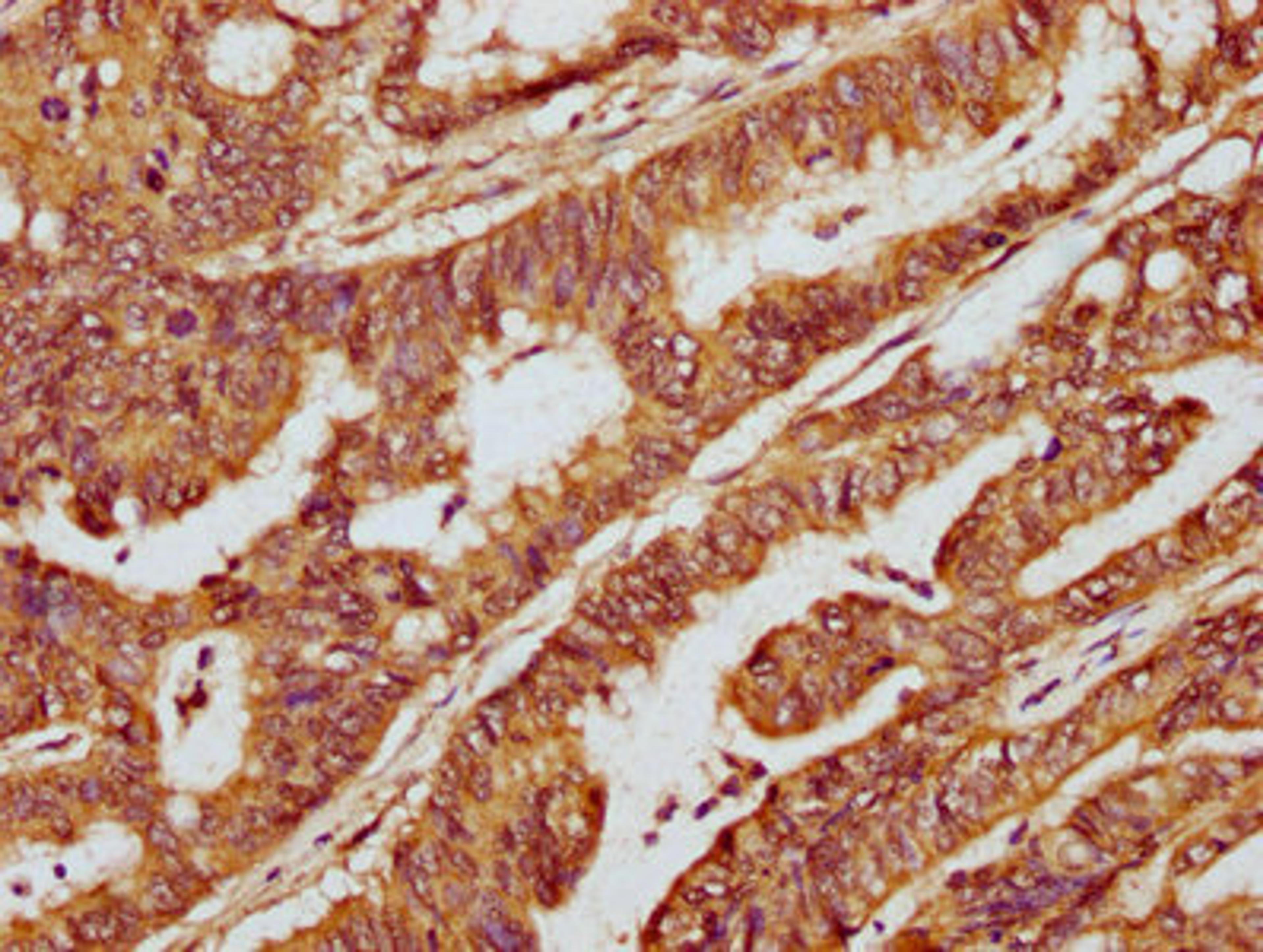 IHC image of CSB-PA715035LA01HU diluted at 1:300 and staining in paraffin-embedded human colon cancer performed on a Leica BondTM system. After dewaxing and hydration, antigen retrieval was mediated by high pressure in a citrate buffer&nbsp;(pH 6.0). Section was blocked with 10% normal goat serum 30min at RT. Then primary antibody&nbsp;(1% BSA) was incubated at 4&deg;C overnight. The primary is detected by a biotinylated secondary antibody and visualized using an HRP conjugated SP system.