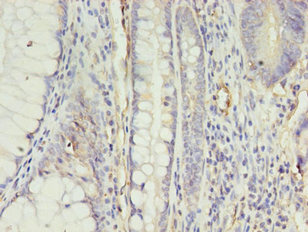 Immunohistochemistry of paraffin-embedded human colon cancer using CSB-PA001910EA01HU at dilution of 1:100