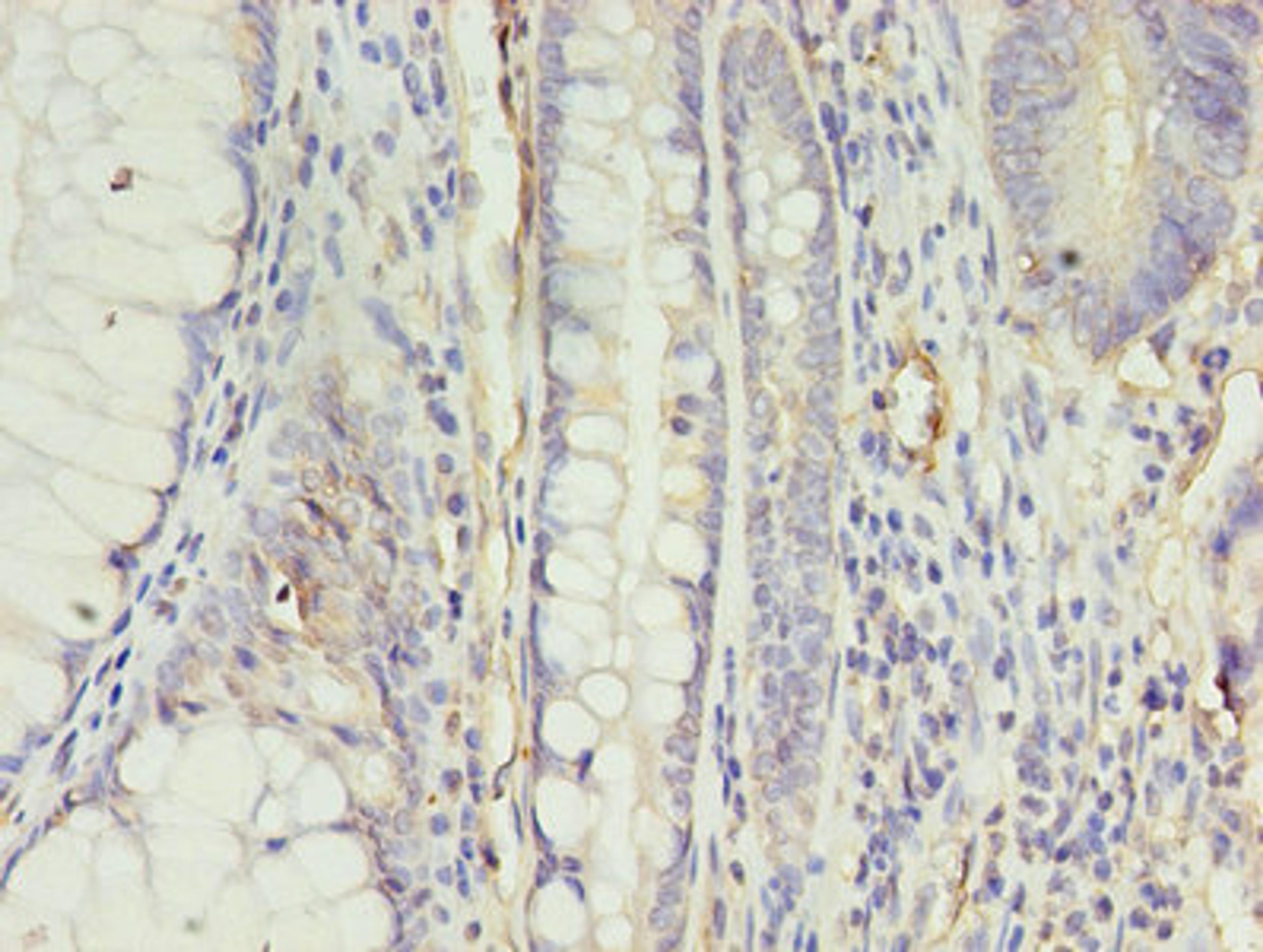 Immunohistochemistry of paraffin-embedded human colon cancer using CSB-PA001910EA01HU at dilution of 1:100