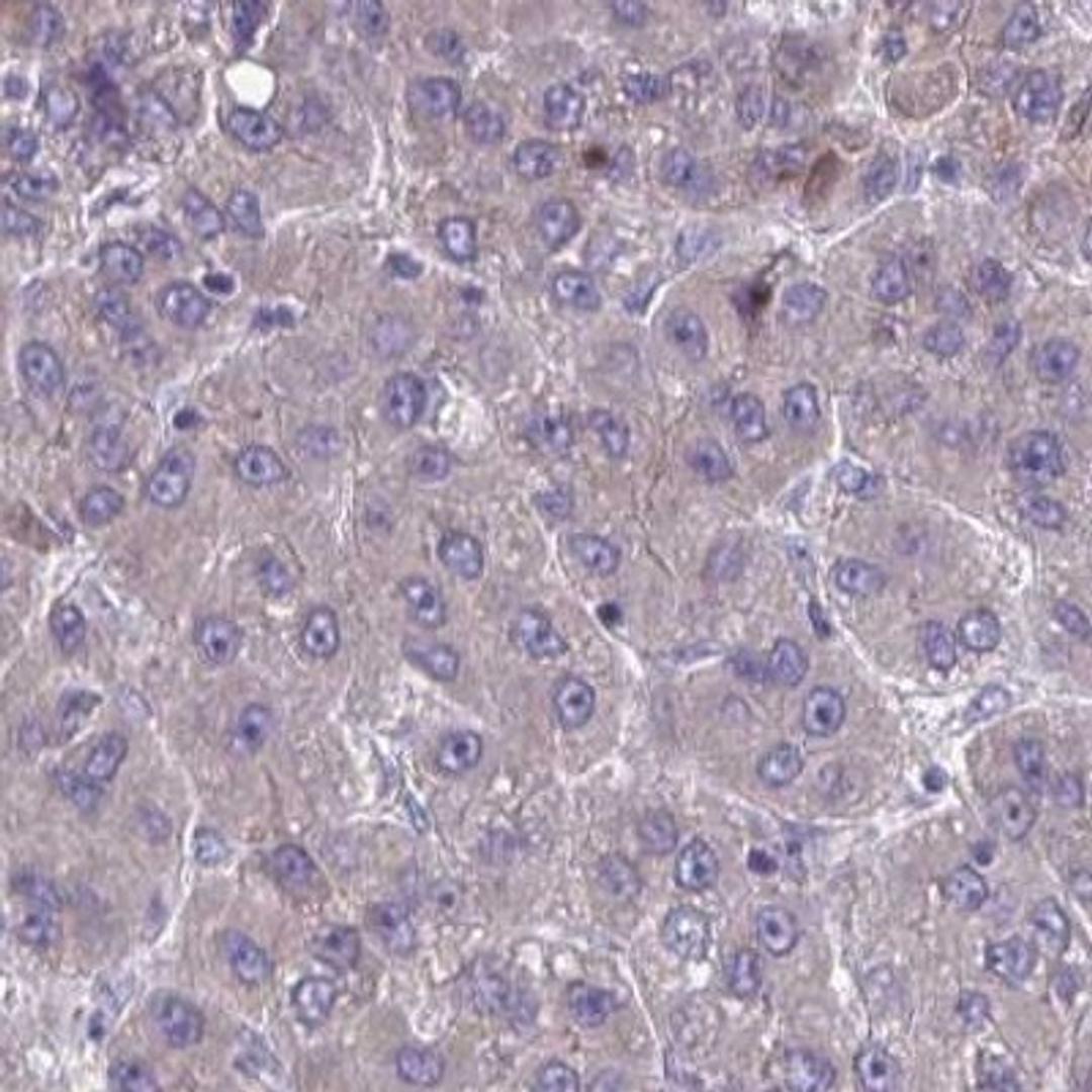 Immunohistochemistry: WBP1 Antibody [NBP2-31660] - liver cancer