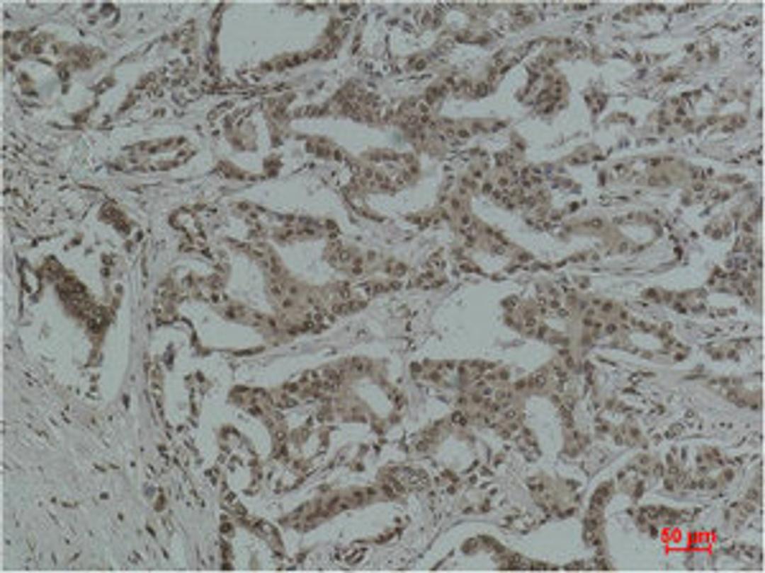 Immunohistochemical analysis of paraffin-embedded Human Breast Carcinoma using Acetyl Lysine Monoclonal Antibody.