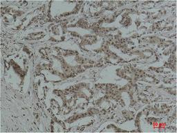 Immunohistochemical analysis of paraffin-embedded Human Breast Carcinoma using Acetyl Lysine Monoclonal Antibody.