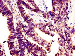 IHC image of CSB-PA12989A0Rb diluted at 1:400 and staining in paraffin-embedded human ovarian cancer performed on a Leica BondTM system. After dewaxing and hydration, antigen retrieval was mediated by high pressure in a citrate buffer (pH 6.0). Section was blocked with 10% normal goat serum 30min at RT. Then primary antibody (1% BSA) was incubated at 4&deg;C overnight. The primary is detected by a biotinylated secondary antibody and visualized using an HRP conjugated SP system.