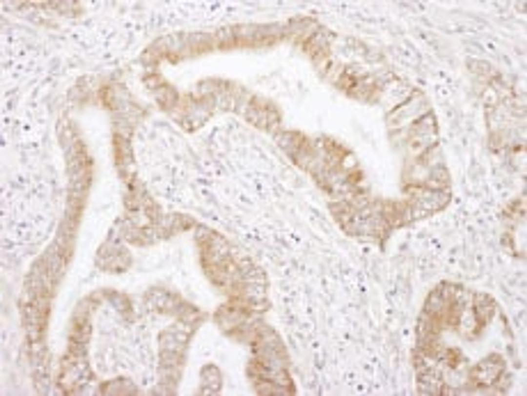 Detection of human Rictor by immunohistochemistry.