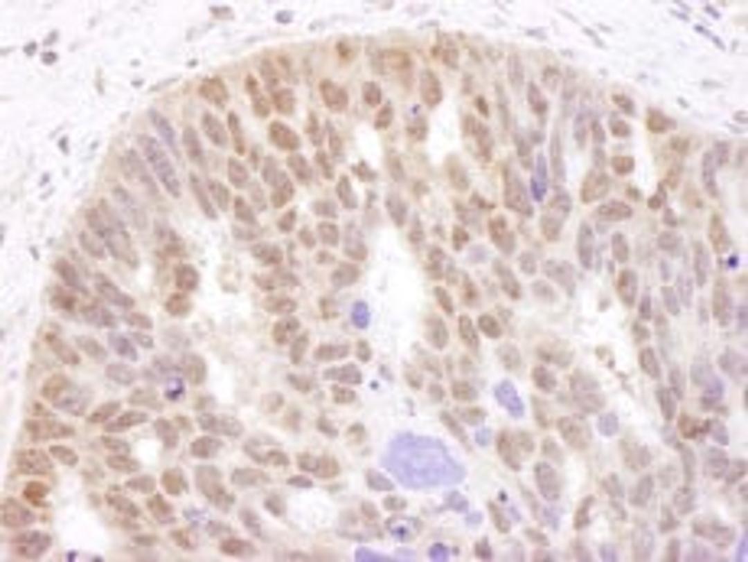 Detection of human Androgen Receptor by immunohistochemistry.