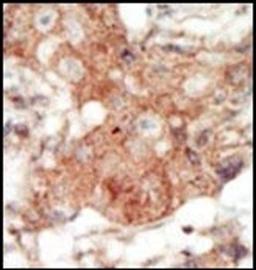 Immunohistochemical staining of paraffin embedded human cancer tissue using EphA4 antibody (primary antibody dilution at: 1:50-100)