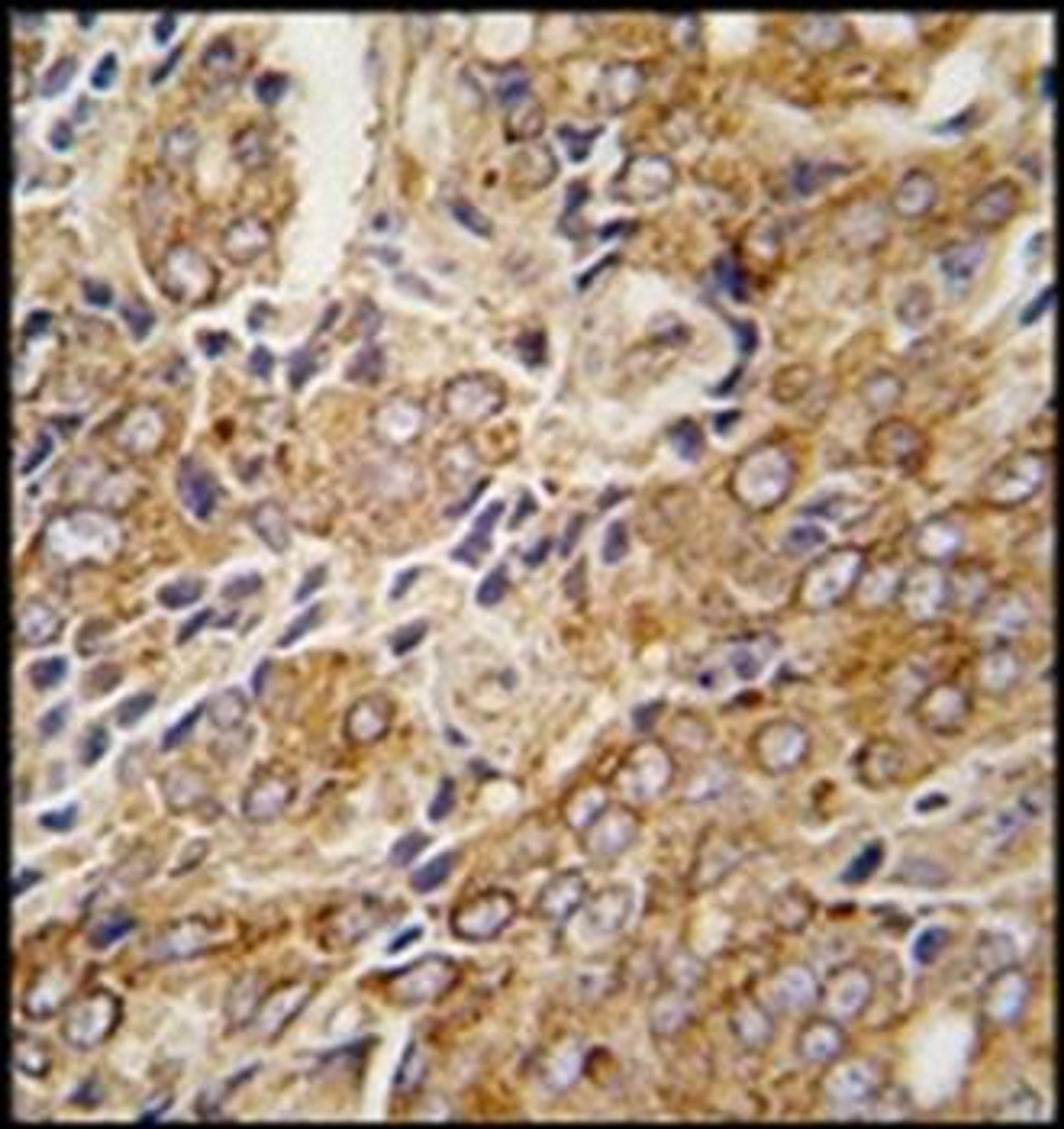 Immunohistochemical staining of paraffin embedded human prostata carcinoma tissue using TRPM8 antibody (primary antibody dilution at: 1:10-50)