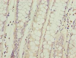 Immunohistochemistry of paraffin-embedded human colon cancer using CSB-PA617993LA01HU at dilution of 1:100