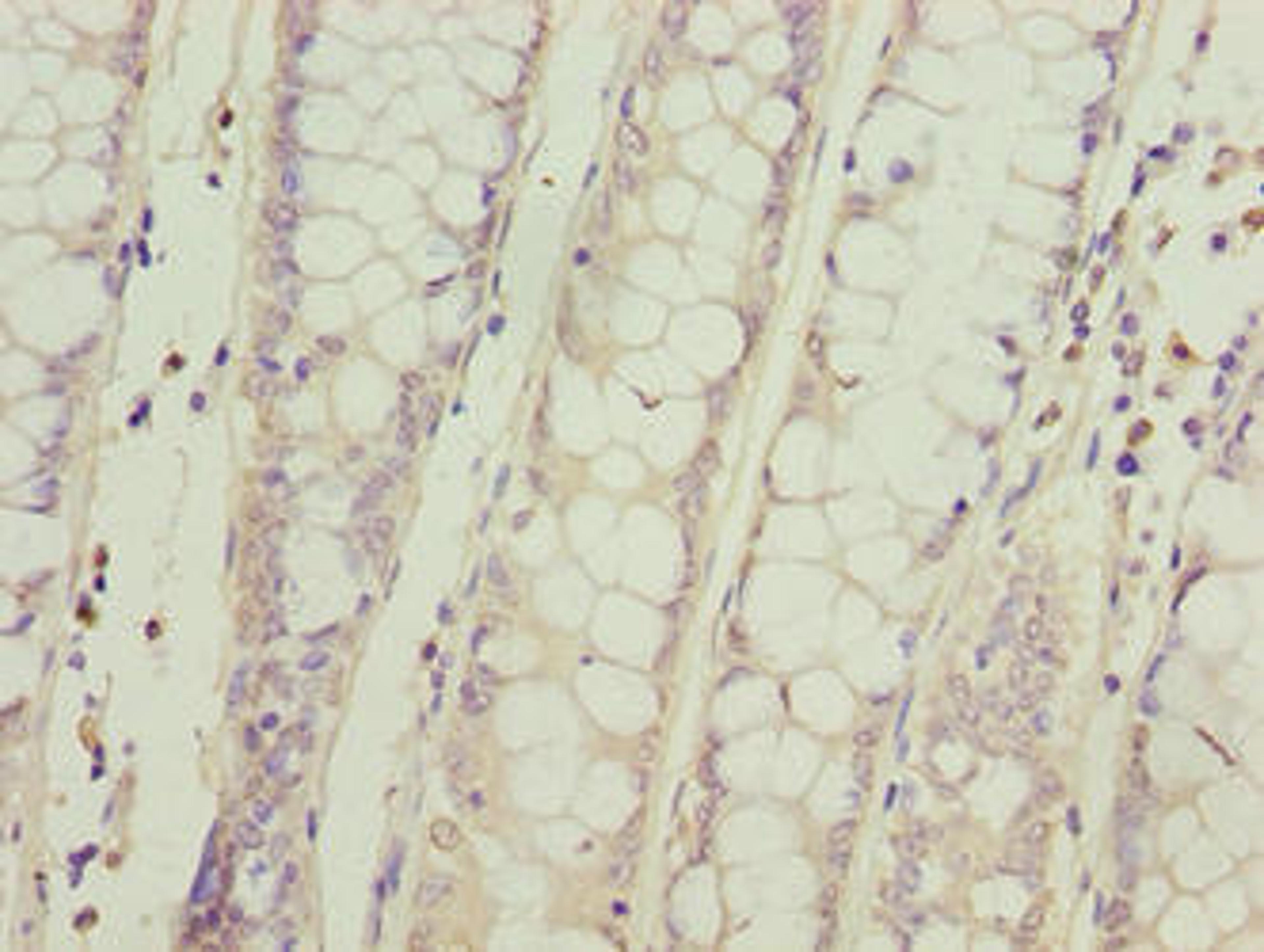 Immunohistochemistry of paraffin-embedded human colon cancer using CSB-PA617993LA01HU at dilution of 1:100