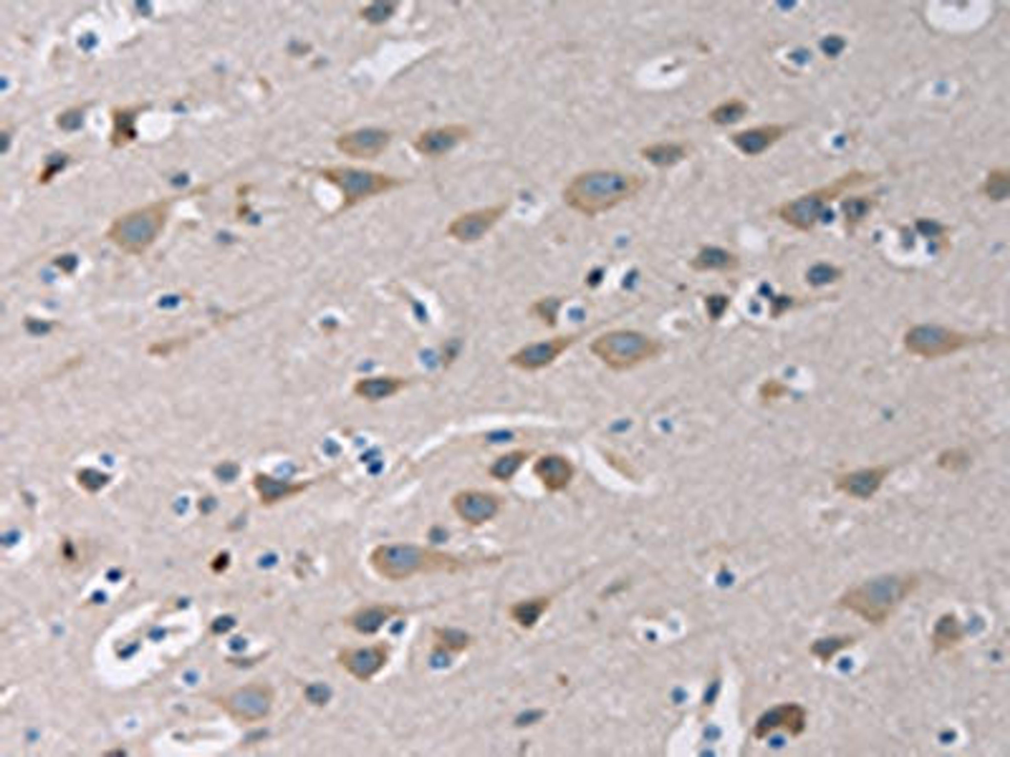The image on the left is immunohistochemistry of paraffin-embedded Human brain tissue using CSB-PA953581(TLR1 Antibody) at dilution 1/20, on the right is treated with fusion protein. (Original magnification: ×200)