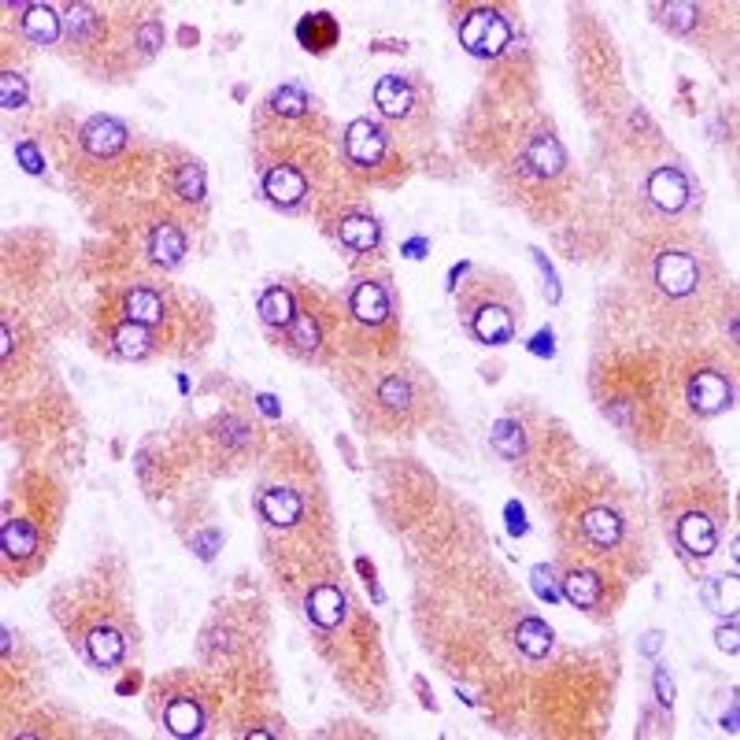 Immunohistochemical staining of human liver cancer tissue using CFHR1 antibody