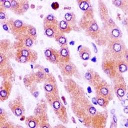 Immunohistochemical staining of human liver cancer tissue using CFHR1 antibody