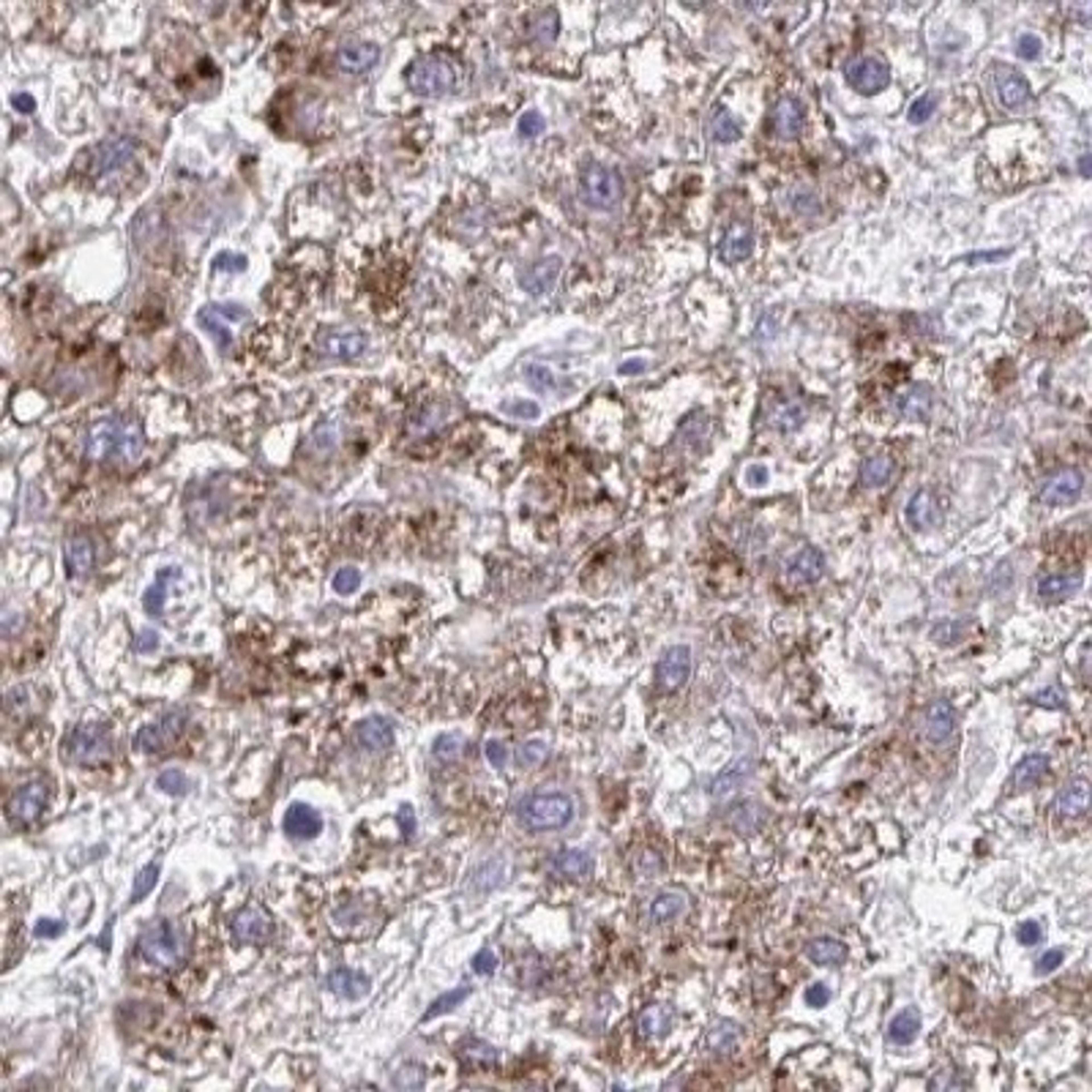 Immunohistochemistry: FAM122C Antibody [NBP2-31805] - liver cancer