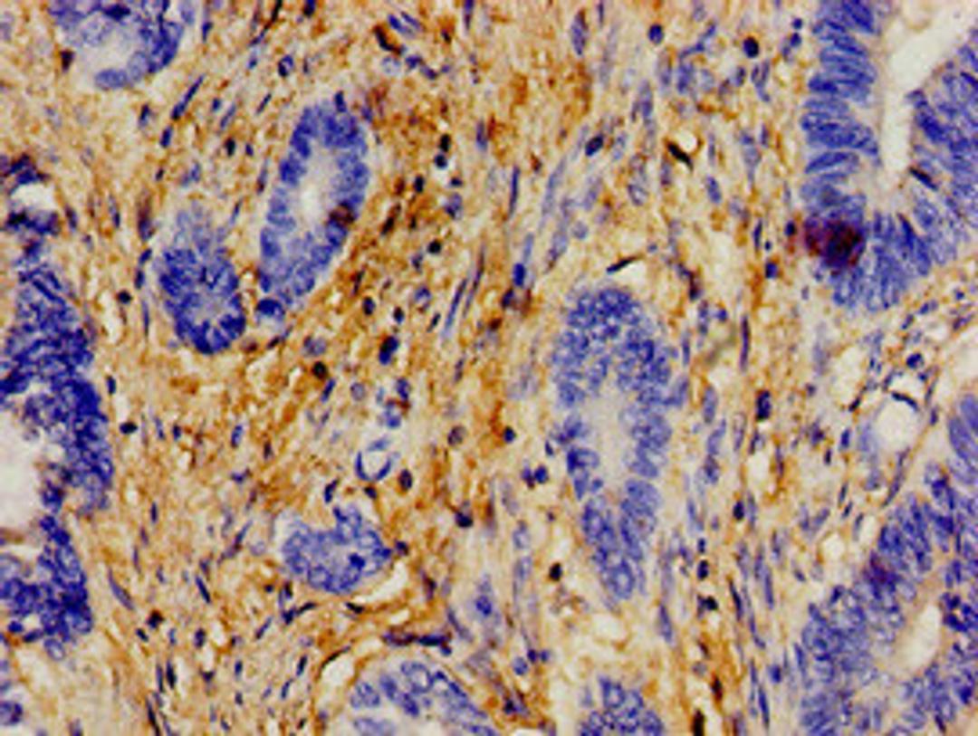 Immunohistochemistry of paraffin-embedded human colon cancer using CSB-PA007759LA01HU at dilution of 1:100