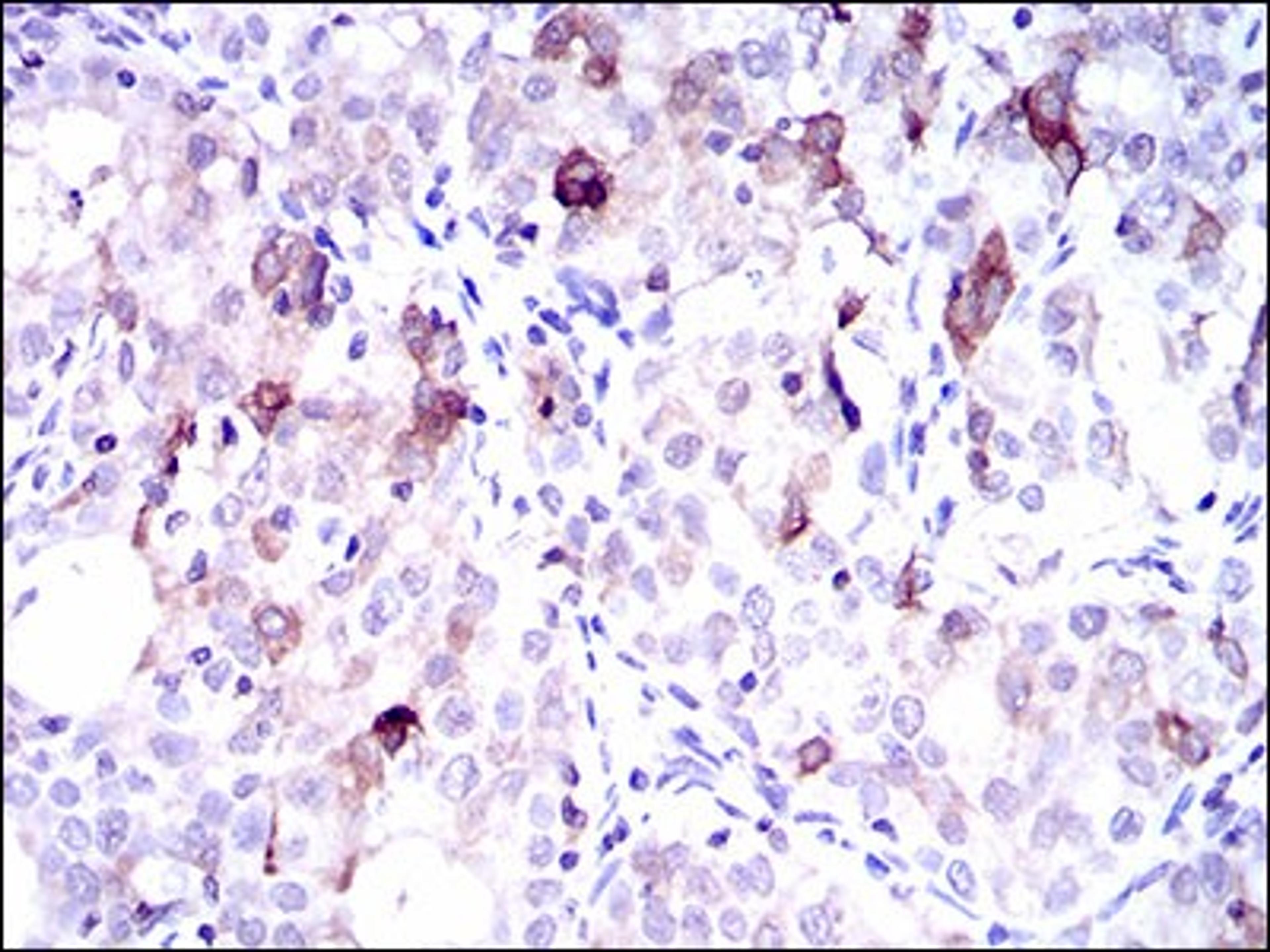 Immunohistochemistry: FATP5/SLC27A5 Antibody (9C4D1) [NBP2-37412] - Immunohistochemical analysis of paraffin-embedded cervical cancer tissues using SLC27A5 mouse mAb with DAB staining.