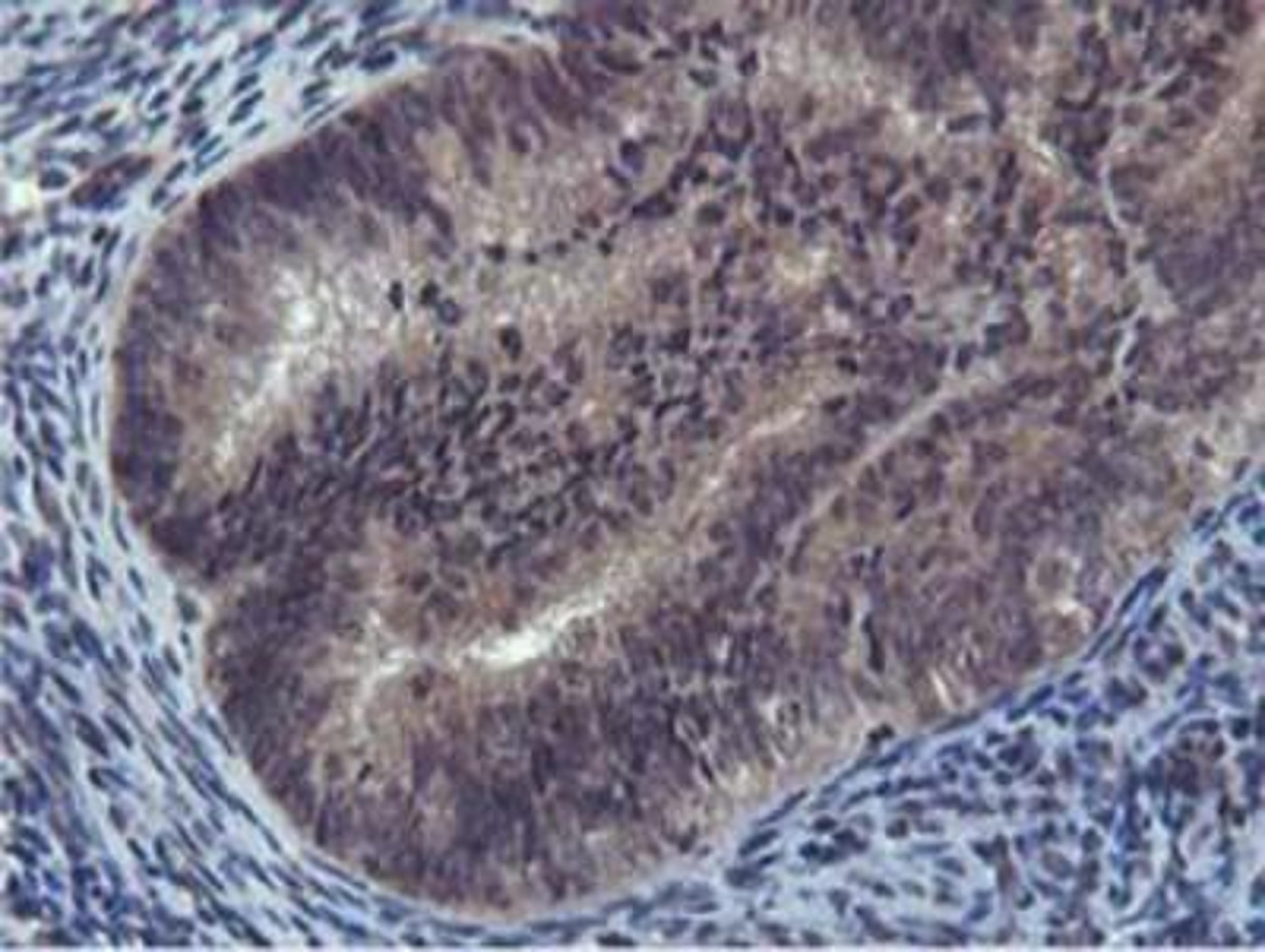 Immunohistochemistry-Paraffin: Cystatin SA Antibody (1D6) [NBP2-01747] - Staining of paraffin-embedded Adenocarcinoma of Human endometrium tissue using anti-CST2 mouse monoclonal antibody.