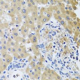 Immunohistochemical staining of human liver injury tissue using RHOB antibody (dilution of 1:100)