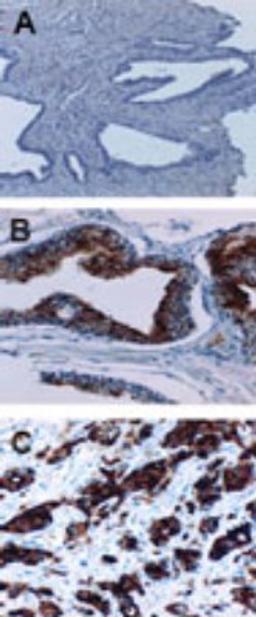 Immunohistochemistry-Paraffin: cIAP1 Antibody [NBP2-27190] - analysis of cIAP1 in formalin-fixed, paraffin-embedded human prostate using this antibody at 1:2000. A, normal prostate. B, prostate intraepithelial neoplasia (PIN). PIN is a premalignant proliferation arising within the prostate. C, prostate cancer. Hematoxylin-eosin counterstain. Increased cIAP1 expression is PIN and in prostate cancer compared to normal prostate.