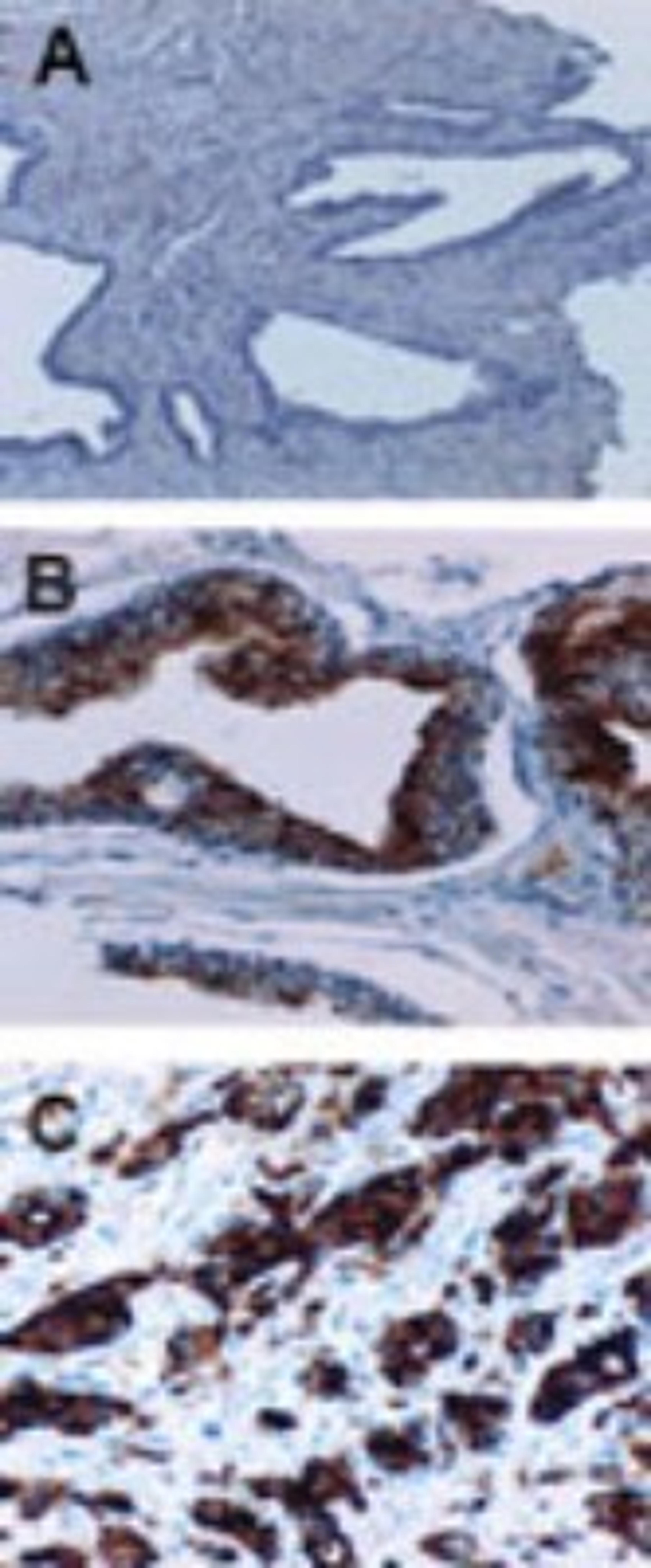 Immunohistochemistry-Paraffin: cIAP1 Antibody [NBP2-27190] - analysis of cIAP1 in formalin-fixed, paraffin-embedded human prostate using this antibody at 1:2000. A, normal prostate. B, prostate intraepithelial neoplasia (PIN). PIN is a premalignant proliferation arising within the prostate. C, prostate cancer. Hematoxylin-eosin counterstain. Increased cIAP1 expression is PIN and in prostate cancer compared to normal prostate.