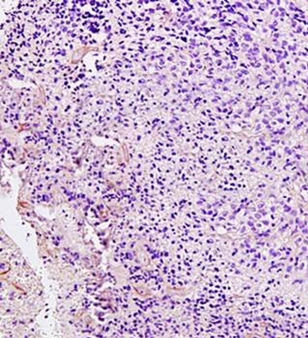 Immunohistochemical analysis of formalin fixed and paraffin embedded human brain glioma using PDGF Receptor beta antibody