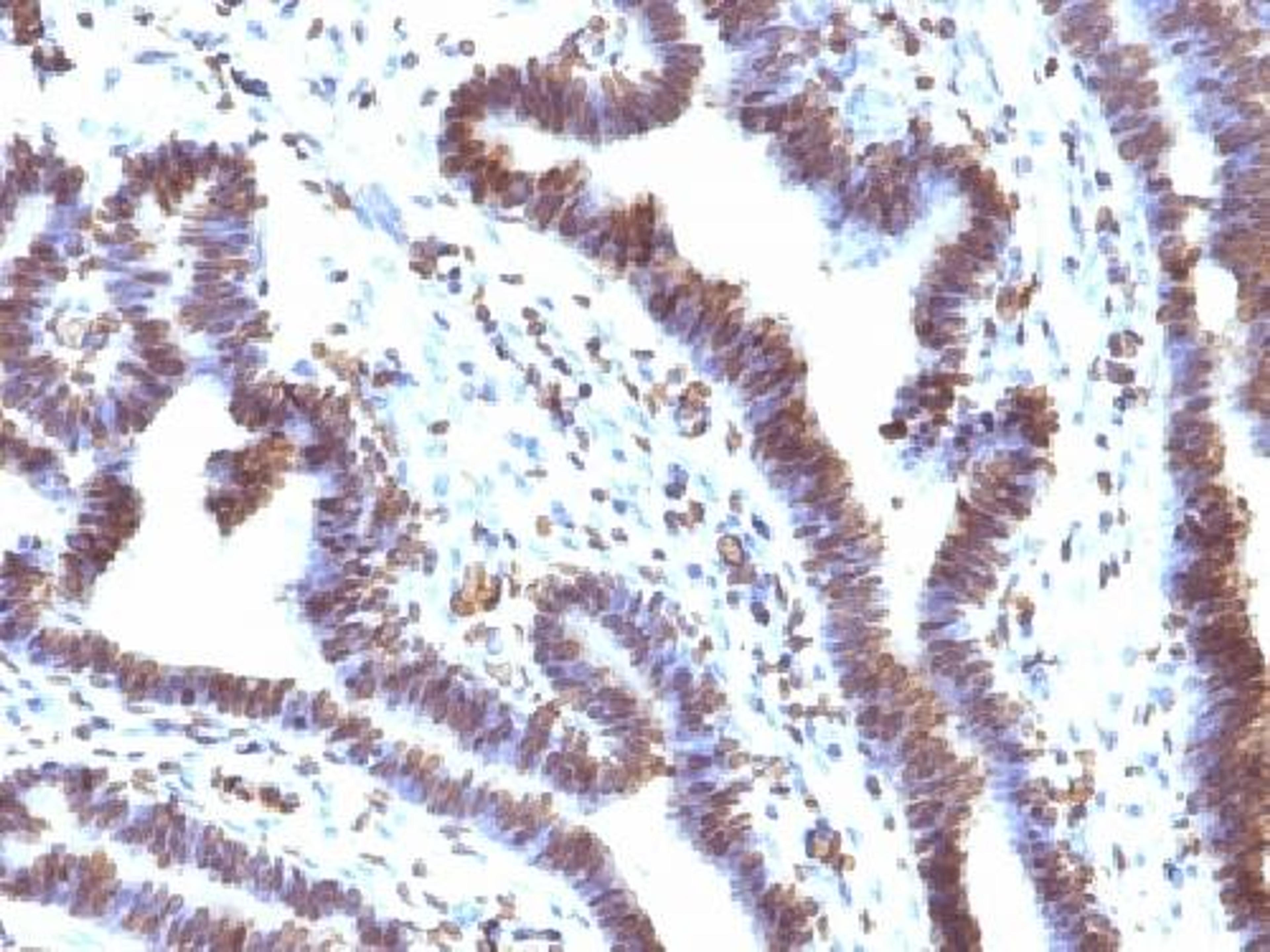 Immunohistochemical staining of human Ovarian Carcinoma tissue using FBXO5 antibody