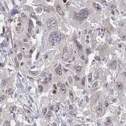 Immunohistochemistry: PIGY Antibody [NBP2-32415] - liver cancer