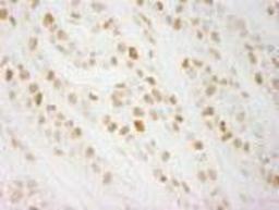 Immunohistochemistry-Paraffin: CHTF18 Antibody [NBP1-03346] - FFPE section of human breast carcinoma. Affinity purified rabbit anti-CTF18 used at a dilution of 1:250.