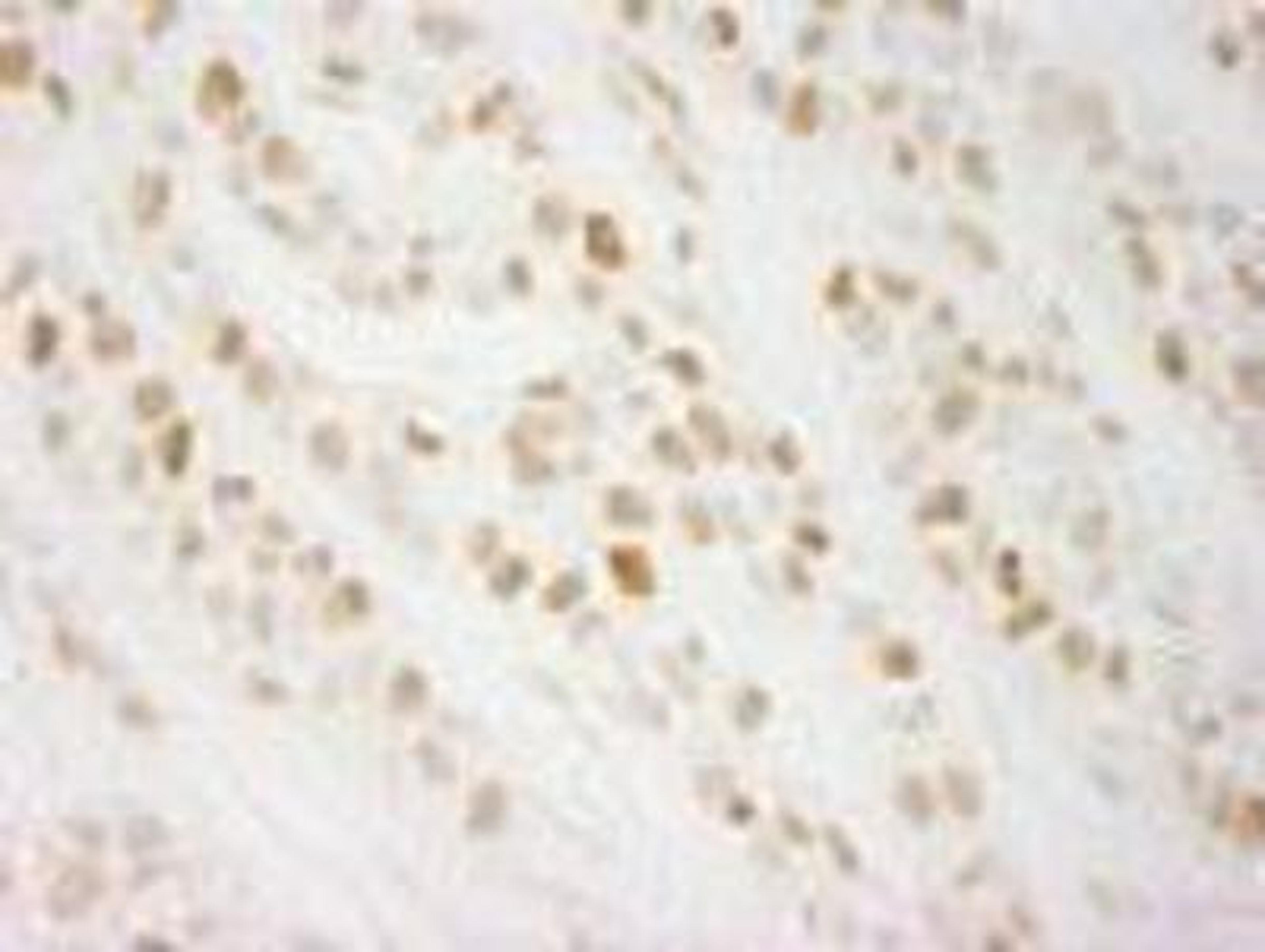 Immunohistochemistry-Paraffin: CHTF18 Antibody [NBP1-03346] - FFPE section of human breast carcinoma. Affinity purified rabbit anti-CTF18 used at a dilution of 1:250.