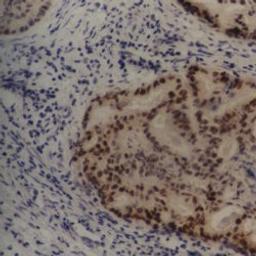 Staining of human breast carcinoma