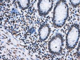 Immunohistochemistry-Paraffin: ATPB Antibody (4E5) [NBP2-02249] - Staining of paraffin-embedded Adenocarcinoma of colon tissue using anti-ATPB mouse monoclonal antibody.