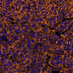 Detection of human PVR/CD155 in FFPE hepatic carcinoma by IHC-IF.