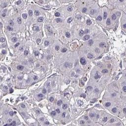 Immunohistochemistry: SKA2 Antibody [NBP2-32443] - liver cancer