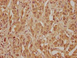 IHC image of CSB-PA863110LA01HU diluted at 1:300 and staining in paraffin-embedded human liver cancer performed on a Leica BondTM system. After dewaxing and hydration, antigen retrieval was mediated by high pressure in a citrate buffer (pH 6.0). Section was blocked with 10% normal goat serum 30min at RT. Then primary antibody (1% BSA) was incubated at 4&deg;C overnight. The primary is detected by a biotinylated secondary antibody and visualized using an HRP conjugated SP system.