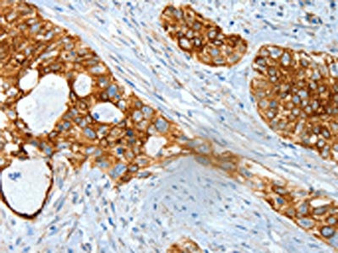 The image on the left is immunohistochemistry of paraffin-embedded Human cervical cancer tissue using CSB-PA243997(KRT18 Antibody) at dilution 1/30, on the right is treated with fusion protein. (Original magnification: ×200)
