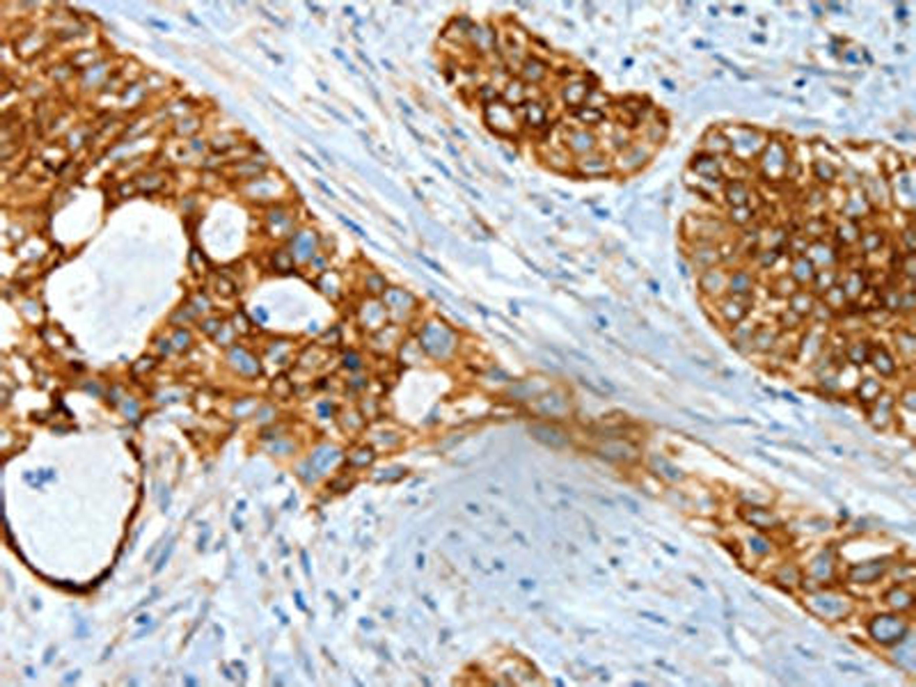 The image on the left is immunohistochemistry of paraffin-embedded Human cervical cancer tissue using CSB-PA243997(KRT18 Antibody) at dilution 1/30, on the right is treated with fusion protein. (Original magnification: ×200)