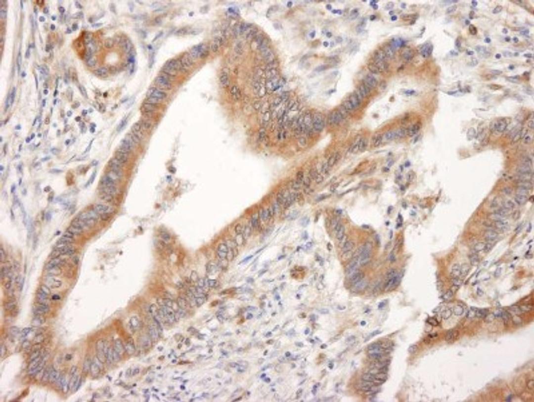 Immunohistochemistry-Paraffin: Bid Antibody [NB500-245] - Human colon carcinoma. Antibody used at a dilution of 1:1000 (1ug/ml).