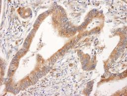 Immunohistochemistry-Paraffin: Bid Antibody [NB500-245] - Human colon carcinoma. Antibody used at a dilution of 1:1000 (1ug/ml).